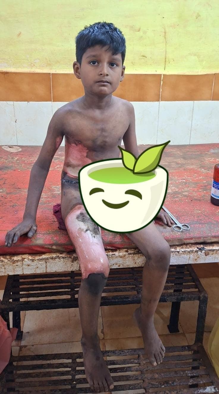 జేబులో పేలిన పవర్ బ్యాంక్!